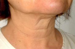 Da cổ bị chảy xệ - Những nguyên nhân và phương pháp làm căng da cổ bị chảy xệ 