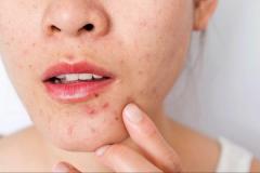 Cách trị vết sẹo thâm trên mặt cực kỳ đơn giản từ thiên nhiên