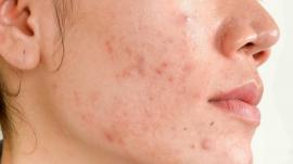 Bị sẹo thâm do mụn phải làm sao? Tiết lộ 3 cách điều trị cực kỳ đơn giản