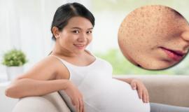 Cách trị nám da dân gian dành giúp mẹ bầu xinh đẹp suốt thai kỳ