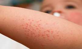 Bảo vệ con khi vào mùa sốt xuất huyết: Là bố mẹ nhất định phải biết