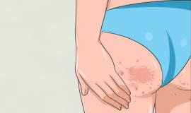 Cách trị thâm mông và thâm vùng kín hiệu quả ngay tại nhà