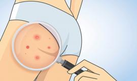 Bỏ túi ngay cách trị thâm khe mông hiệu quả tại nhà cực đơn giản
