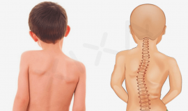 Bố mẹ nên làm cách nào để bé không bị gù lưng?
