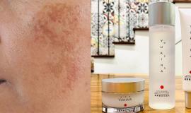 Cách dùng bộ trị nám Yukina đạt hiệu quả cao chỉ sau 2 tuần sử dụng