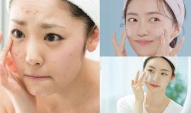 Hành trình phục hồi da mụn với mỹ phẩm Nhật Bản