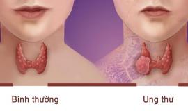 [GIẢI ĐÁP] Ung thư tuyến giáp có được ăn lạc không?