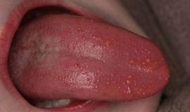 [Lý giải] Cuống lưỡi nổi mụn thịt không đau là bị gì?