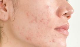 Cách phục hồi da bị kích ứng do thời tiết và mỹ phẩm cực hiệu quả