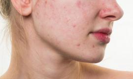 Cách phục hồi da bị dị ứng mỹ phẩm vừa nhanh vừa hiệu quả dành cho người bận rộn