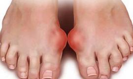 Các loại thuốc điều trị Gout của Nhật tốt nhất hiện nay