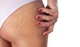 Tại sao bị rạn da ở tuổi dậy thì? Nguyên nhân và cách khắc phục