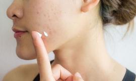 Khi nào nên dùng serum trị mụn để mang lại hiệu quả cao cho làn da đang bị tổn thương